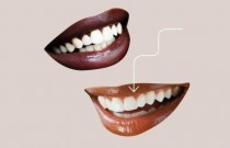 Clareamento Dental: Remova o tártaro e deixa os dentes mais brancos!