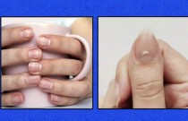 Manchas brancas nas unhas: o que são, causas e tratamentos