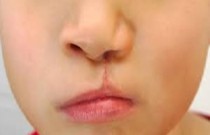 Lábio leporino - malformação máxilo-facial