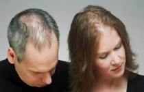 Queda de cabelo pode está relacionada à distúrbios emocionais.