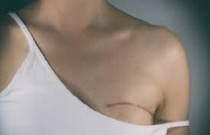 Mastectomia - retirada da mama