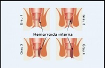 Cirurgia para remover hemorroida e terminar com a dor