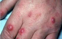 Criptococose - doença infecciosa causada por fungo