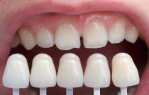 Colocar porcelana (lentes de contato ou faceta) nos dentes... vale a pena?