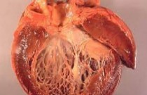 Fibrose cardíaca - tudo que você precisa saber sobre essa doença!