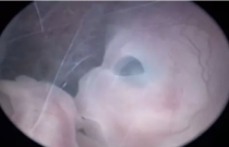 Vídeo de um feto de 10 semanas dentro do útero viraliza