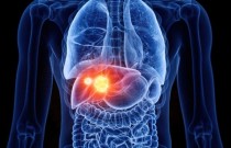 Câncer de fígado: alertas, sintomas e tratamento