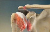 Artrite e osteoartrite - sintomas que você desconhece