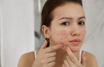 Dicas de como combater a acne