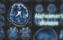 Novo estudo identifica fator-chave para desenvolvimento do Alzheimer