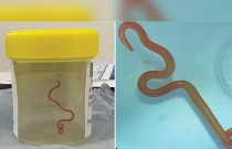 Encontrar um verme cerebral vivo é raro: 4 maneiras de se proteger de parasitas comuns