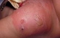 Úlceras de decúbito - necrose tecidual da pele