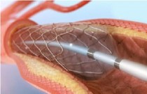 Angioplastia - procedimento cirúrgico para desobstruir artérias
