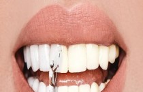 7 Hábitos que prejudicam os dentes; além da falta de higiene