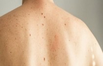 Dezembro Laranja: Dermatologista ensina quais são os sinais de alerta e sintomas do Câncer