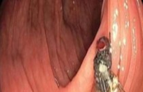 Médicos encontram mosca viva no intestino de paciente durante exame
