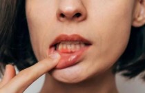 Hipótese liga a peste bubônica à saúde bucal moderna
