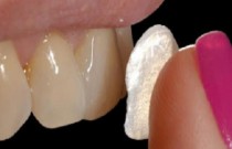 Lente de contato dental - quais as vantagens e restrições deste procedimento?