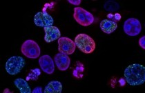 Microplásticos podem se acumular nas células cancerígenas e podem ajudá-las a se espalhar