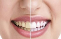 Mitos e verdades sobre o clareamento artificial dos dentes