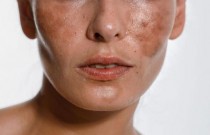 O que causa manchas escuras na pele das mulheres?