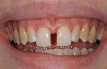 Diastema - afastamento entre os dentes centrais