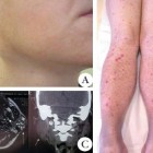 Granulomatose linfomatóide - desordem na proliferação das células do sangue