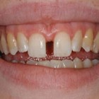 Diastema - afastamento entre os dentes centrais
