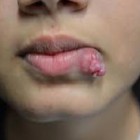 Fibromatose agressiva - tumor benigno do tecido conjuntivo
