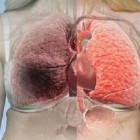 Blastoma pulmonar - tumor de crescimento rápido