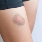 7 itens que podem significar aqueles roxos que aparecem do nada no seu corpo