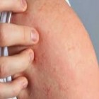 Urticária aquagênica - a rara alergia a água