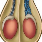 Varicocele - dilatação dos vasos testiculares