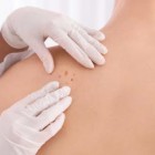 Médico lista sinais simples para saber se pinta é câncer de pele