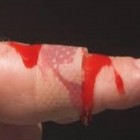 Hemofilia - deficiência na coagulação do sangue