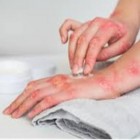 Dermatite herpetiforme - sensação de queimadura intensa