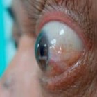 Quemose conjuntival - é uma condição que causa dor, coceira e inchaço nos olhos