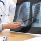 Estado do Brasil vive boom de pneumonia e casos quase triplicam em três anos