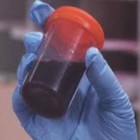 Urina preta - doença misteriosa que causa fortes dores musculares