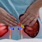 Cálculo renal - confira 7 sintomas que indicam o problema