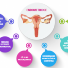 Endometriose: sintomas, diagnóstico e tratamentos