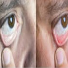 Anemia - veja como tratar com remédios naturais