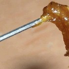 Como remover a cera de ouvido corretamente?