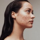 8 dicas para aqueles que possuem acne