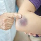 Você tem hematomas frequentes? Pode ser algo sério!