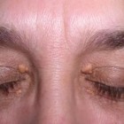 Estudo aponta que manchas amareladas nos olhos podem indicar risco de AVC
