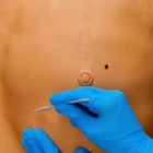 A cesariana e as consequências nas mulheres