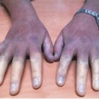 7 sinais da terrível e enigmática síndrome de Raynaud