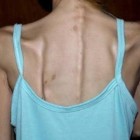 Britânica com anorexia nervosa chegou a pesar 31 kg