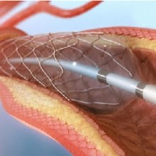 Angioplastia - procedimento cirúrgico para desobstruir artérias